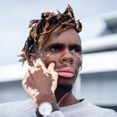 Man with Vitiligo skin disorder